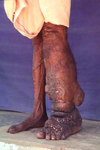 filariasis leg 200x300